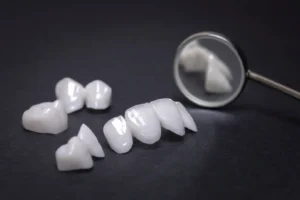 Dental veneer restorations and a dental mirror arranged on a dark surface.
