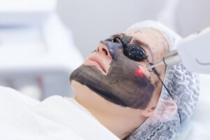Person wearing protective eye shields receives laser treatment over a facial mask during a skin procedure.